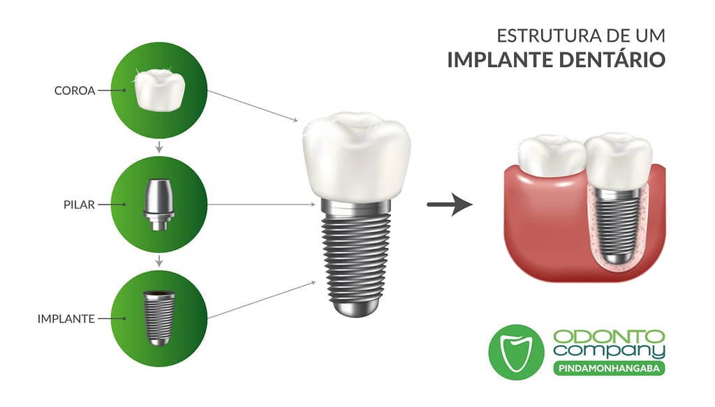 Estrutura de um implante dentário, tratamento realizado na OdontoCompany Pindamonhangaba